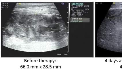 又一抗癌利器崛起！CAR-NK细胞疗法成功缩小肿瘤病灶，控制腹水，不仅抗癌，还能“攻击”红斑狼疮！