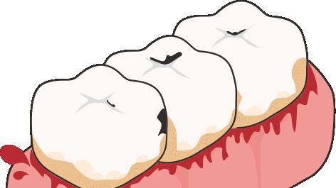 洗牙后牙龈出血正常吗？