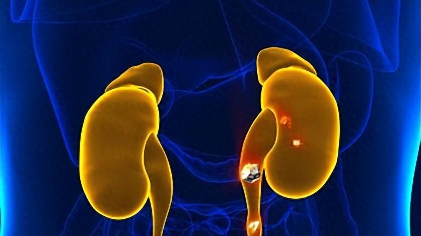 总是腰痛？半夜被痛醒？这可能肾结石在作怪，5个习惯容易有结石