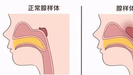 “腺样体肥大” 孩子成长路上的隐形“绊脚石”，家长需警惕！