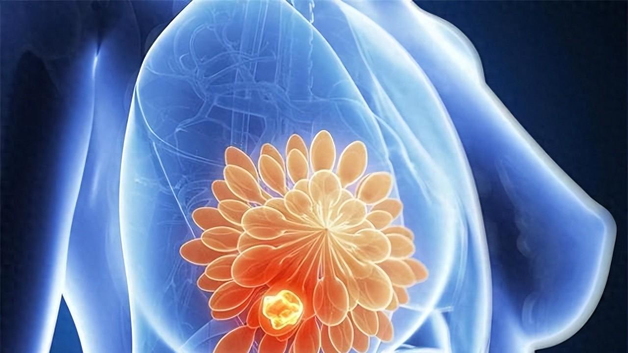 乳房突然红肿热痛？乳腺炎不只是妈妈病，非哺乳期女性也可能中招