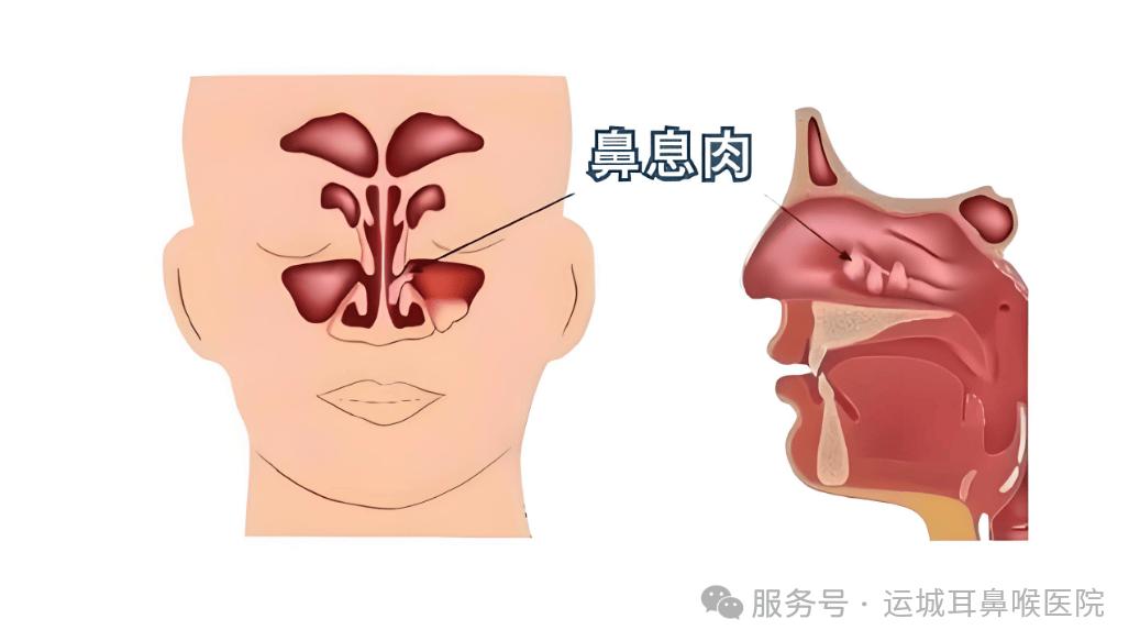 别等鼻息肉加重才重视！搞懂病因、做好防护！