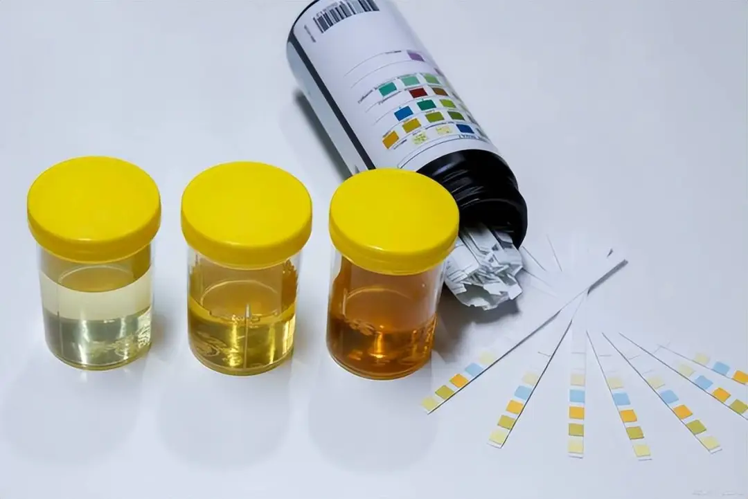 肾功能丧失的原因终于找到了，不是肌酐高！教你2招恢复肾功能！