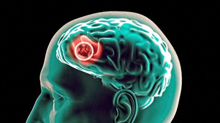 总觉得自己脑子不够用了？你的大脑悄悄缩水，小心脑萎缩