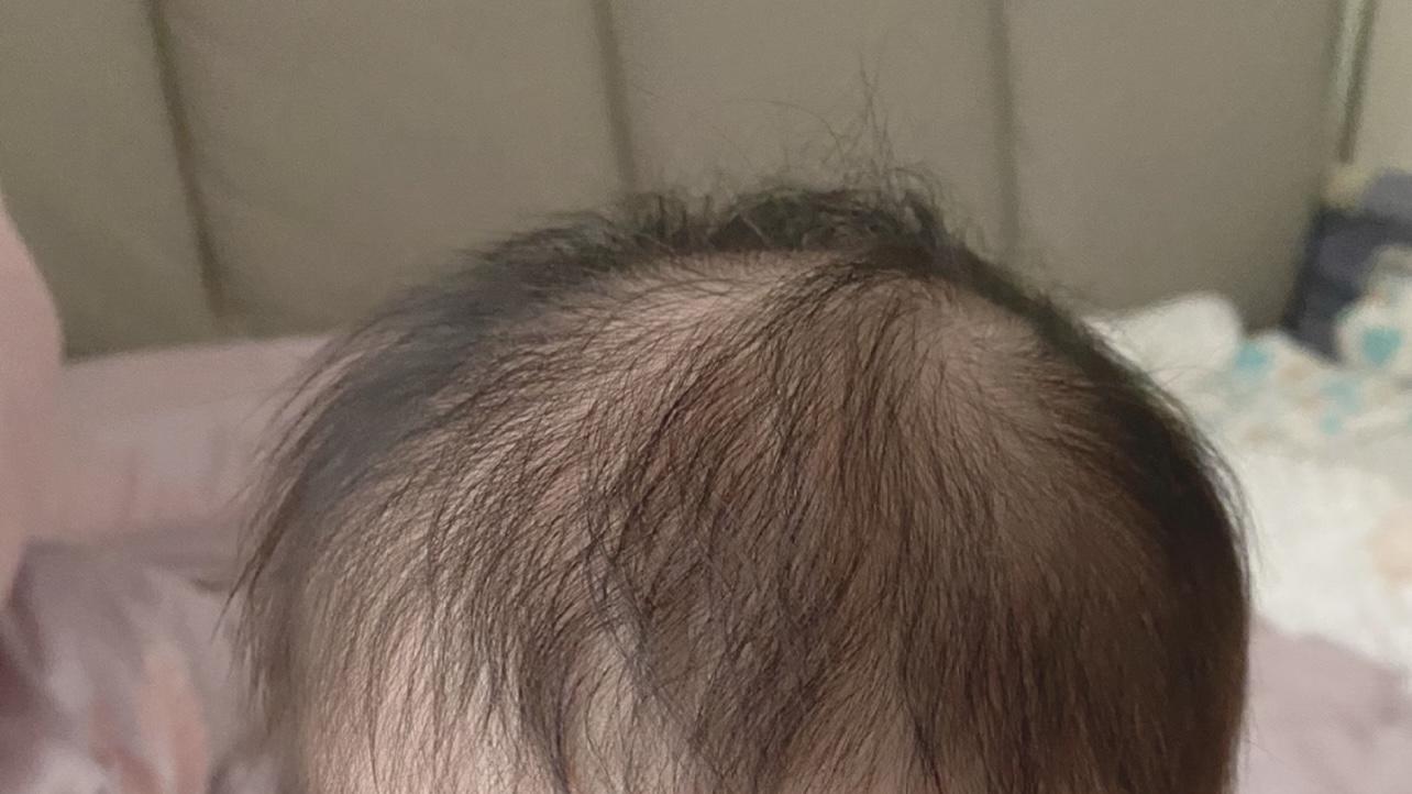 宝宝后脑勺秃了一圈？别慌！枕秃不等于缺钙！