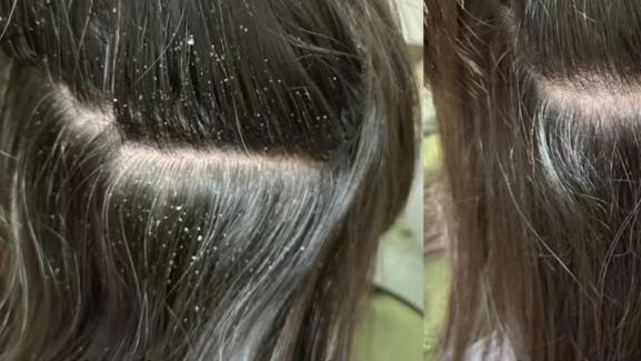 头痒、头屑、断发折磨我两年，28天真实记录（纯个人分享）