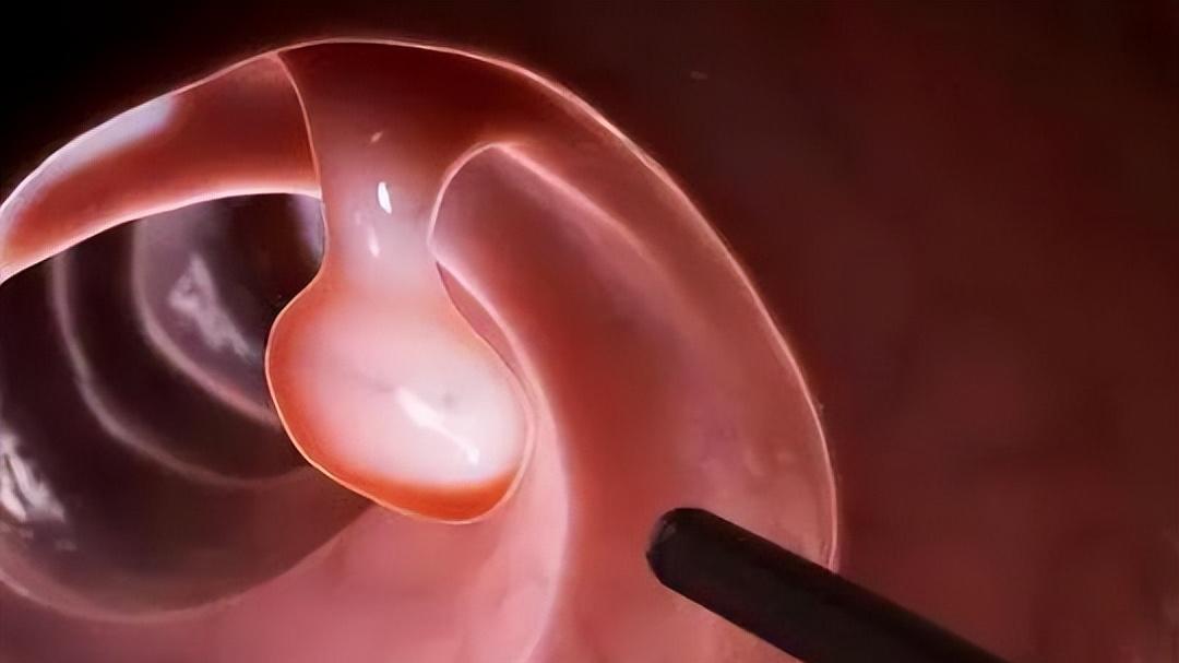 息肉用乌梅，结节用牡蛎，囊肿用夏枯草！中药用对了，包块都能消