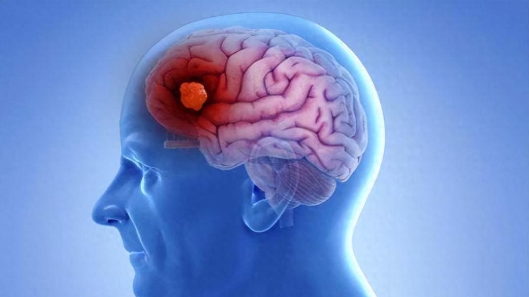 健忘就是大脑在萎缩？不一定，6个习惯预防脑萎缩，越早做越有效