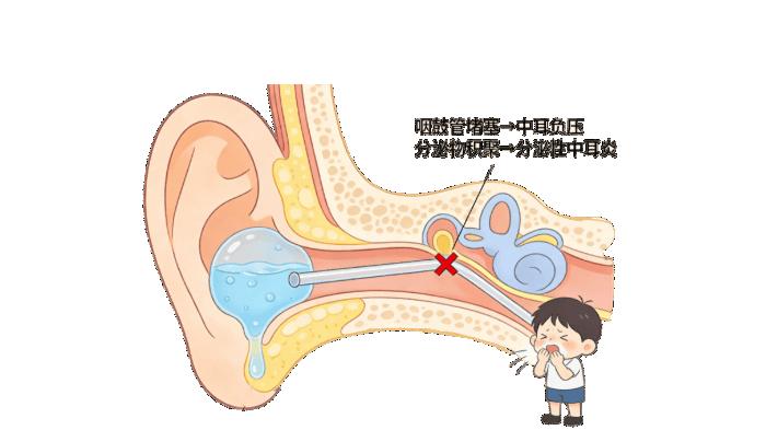 感冒后耳朵嗡嗡响、听不清？小心“分泌性中耳炎”