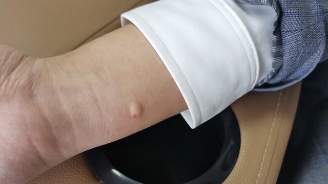 打针起硬块发红，不是全算医疗过错！出现这些情况才能找医院索赔