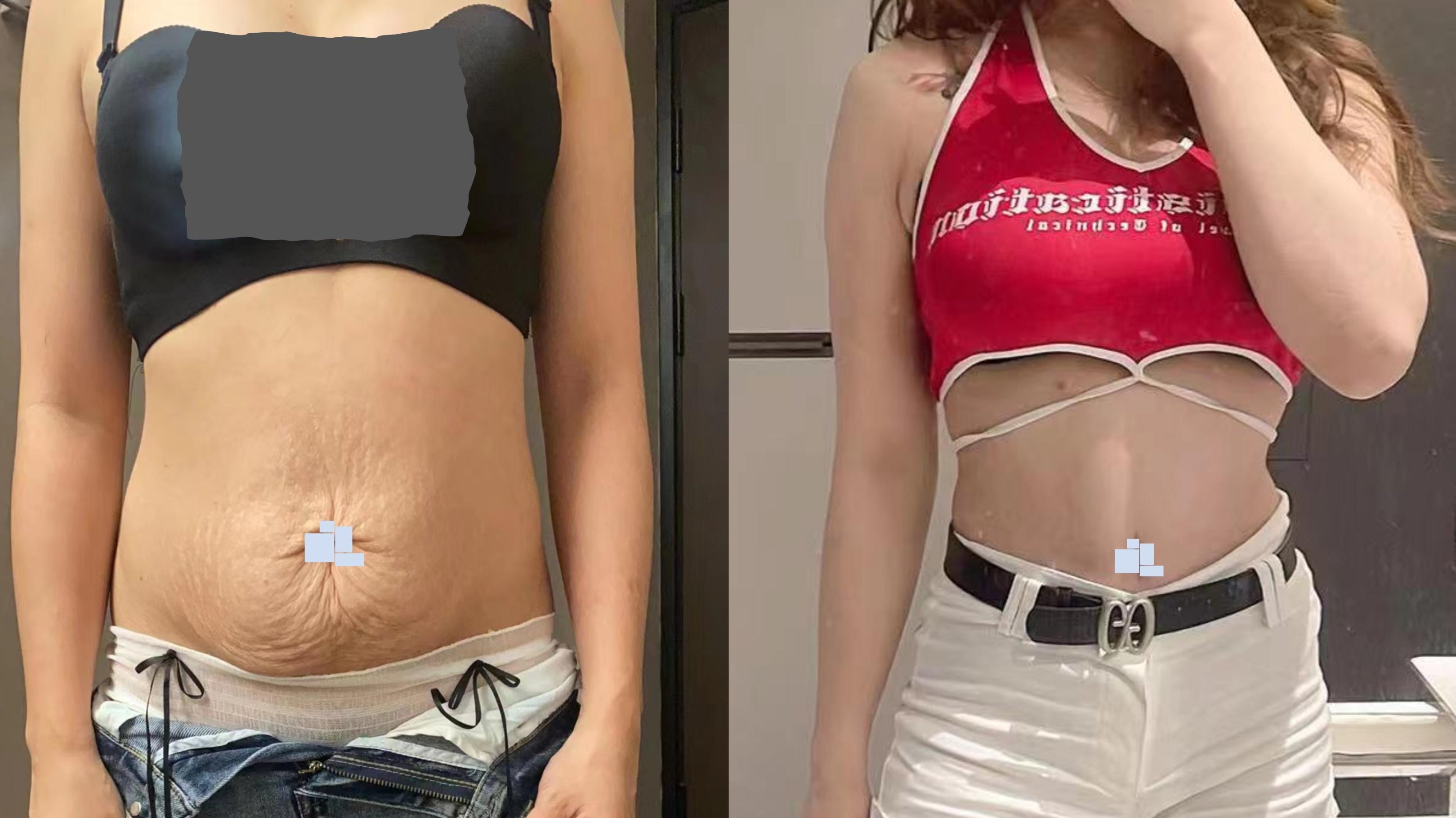 杨杰教授讲解：DFS腹壁成形术，如何实现功能修复和形体重塑