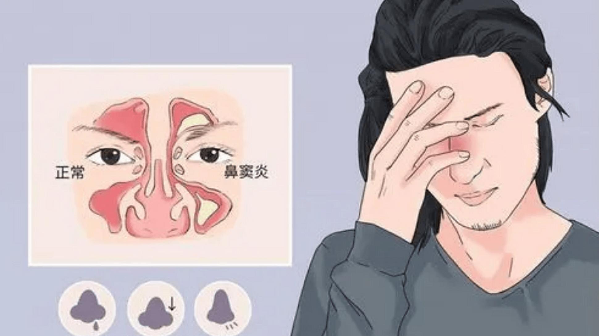鼻子里也会发霉吗？——聊聊真菌性鼻窦炎