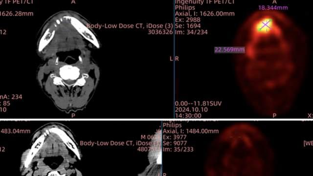 50%晚期肉瘤患者肿瘤显著缩小！TIL疗法打出50%有效率，为晚期肉瘤、肺癌、宫颈癌患者持久获益