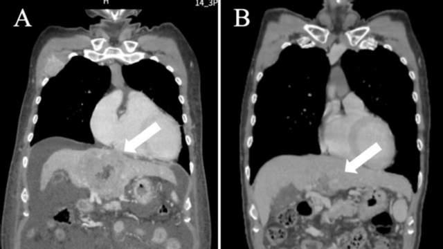 肿瘤缩小、腹水消失！DC-NK联军为晚期肝癌、子宫内膜癌患者打开新通道，转移灶清零