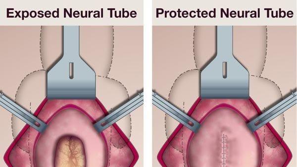 ​柳叶刀：全球首例干细胞疗法有望用于治疗子宫内脊柱裂