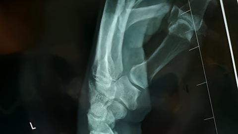 交通事故骨折≠十级伤残！评级的7个潜规则，第三步看懂多拿赔偿