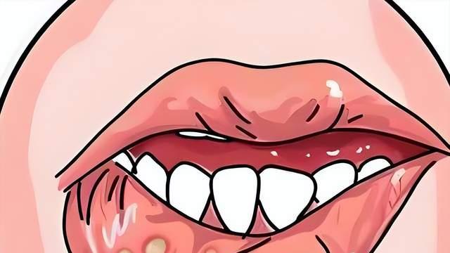 口腔反复溃烂不愈合？7类人群做好预防，别把口腔癌当成口腔溃疡