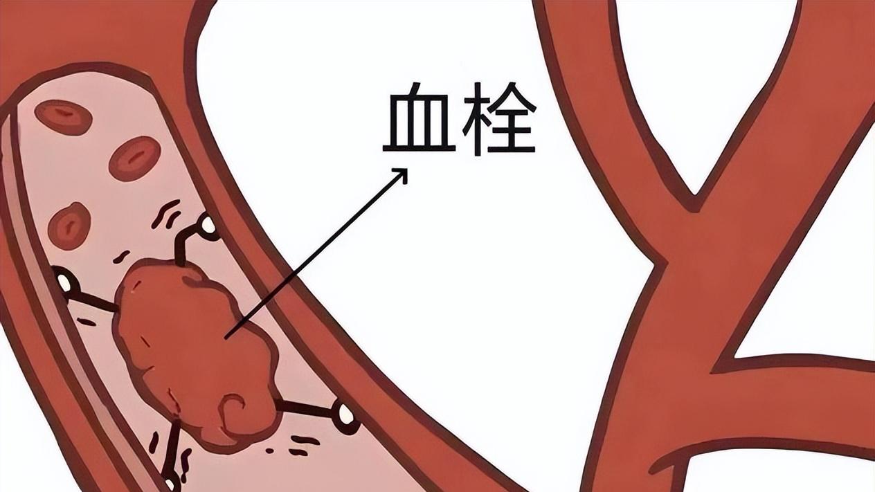 血管里埋雷？医生提示：90%的血栓可预防，出现这些症状，别拖延