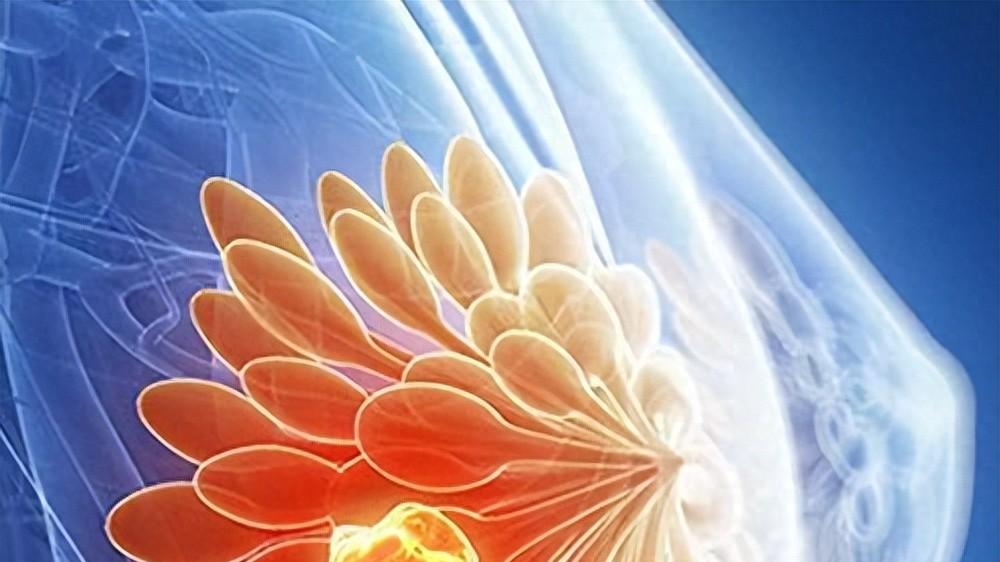 确诊乳腺癌以为天塌了？但早期治愈率超过90%，7类症状别忽视