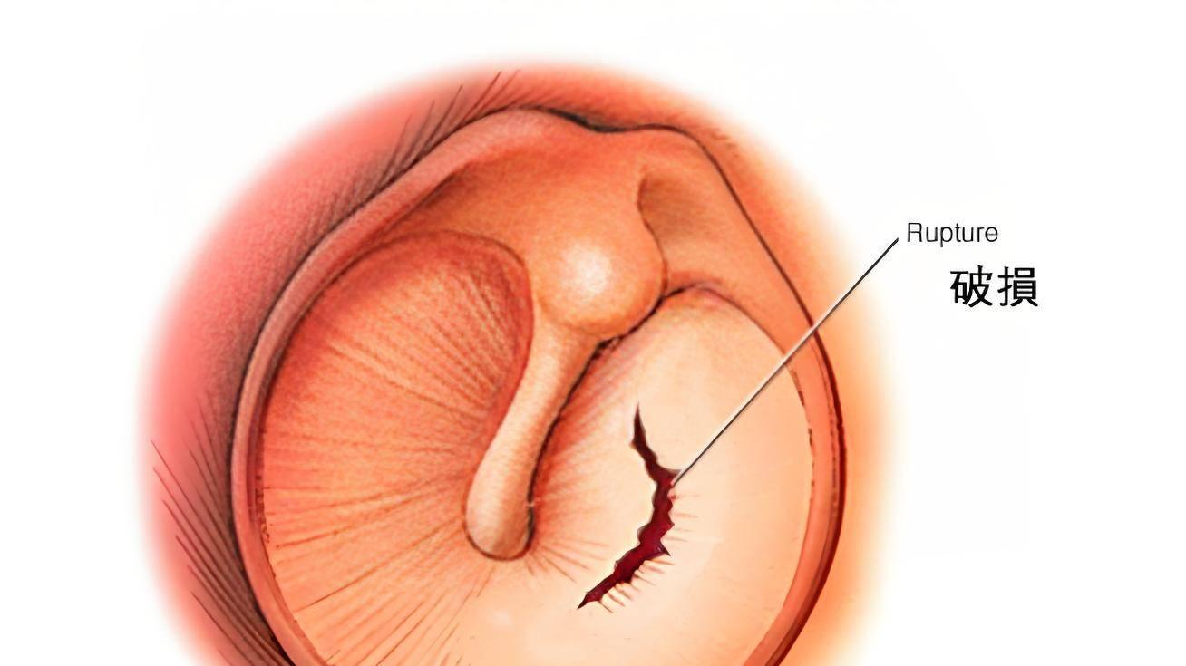 “掏耳朵”变“伤耳朵”——鼓膜穿孔非小事，可能永久损伤听力！