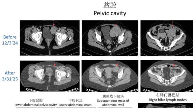20年生命奇迹！DC疫苗在脑瘤、卵巢癌、黑色素瘤中接连取得突破性生存获益，部分晚期患者存活超10年