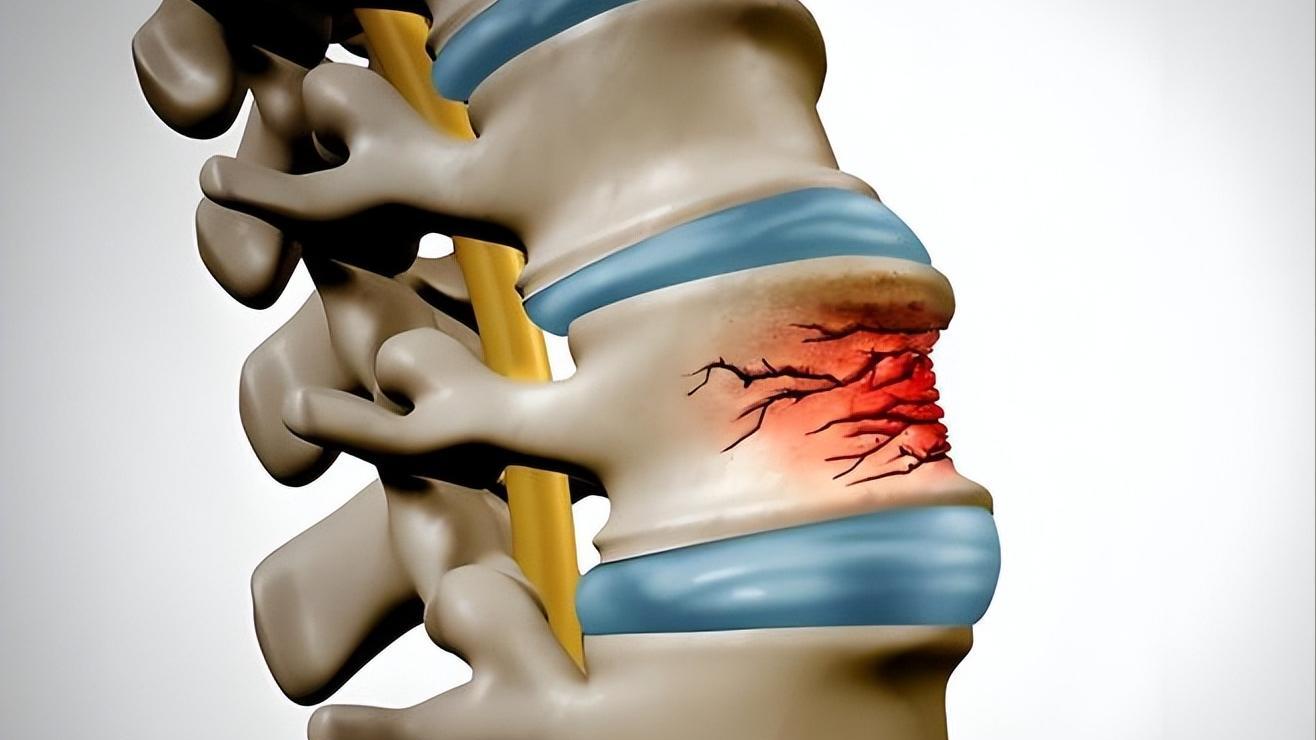 腰痛忍一忍就过去了？出现4类症状，小心腰间盘突出，4个坑别踩