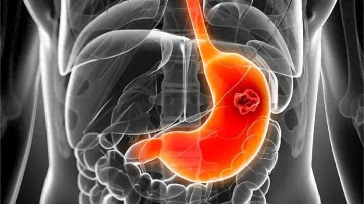 胃里长出石头？3个习惯容易胃结石，出现腹痛、呕吐，千万别硬扛