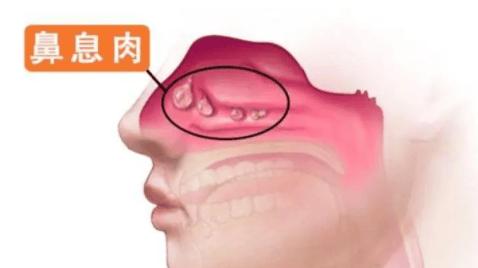 鼻子里的“肉球”切了又长？容易复发的鼻息肉如何预防？