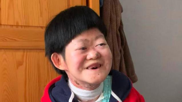 25岁“蝴蝶宝贝”打破预言，曾被告知活不过2岁