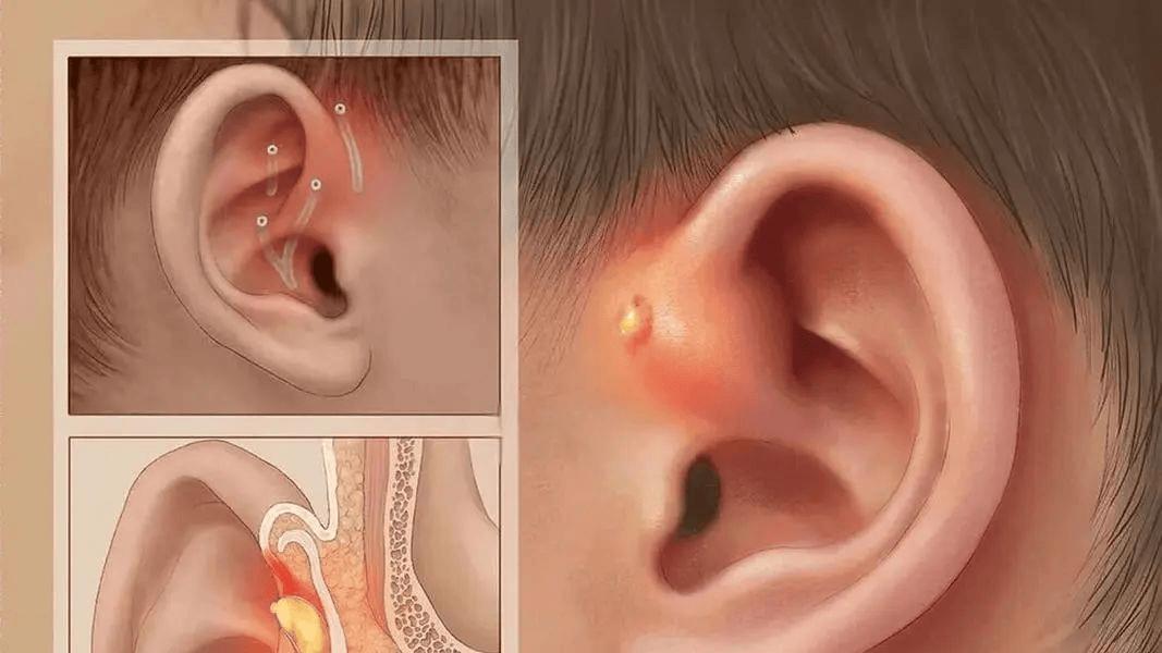 宝宝耳前有个“小针眼”？别忽视，这可能是耳前瘘管！