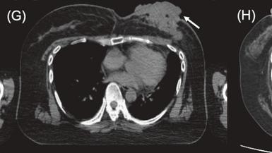 客观缓解率达80.5%！中国硼中子俘获疗法（BNCT）加速落地，国产硼药获突破性认定