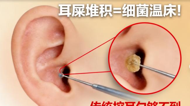 掏耳勺哪个品牌好？2026高清可视采耳设备，挖耳勺最好的牌子安利！