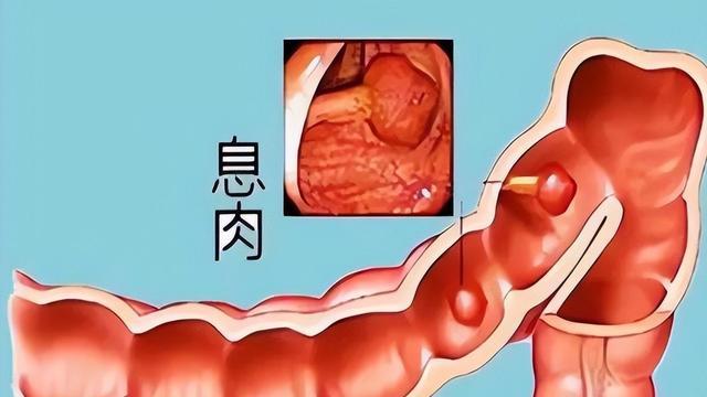 胃肠息肉最怕复发，1张中药方，调脾清热化瘀，复发率比手术低