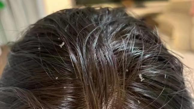 2026最新实测：去头皮屑最有效的洗发水深度评测报告