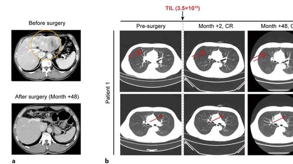 CAR-T之后，TIL疗法崛起！不只是黑色素瘤，肺癌、肝癌、宫颈癌患者也有救了，多名患者无癌超4年！