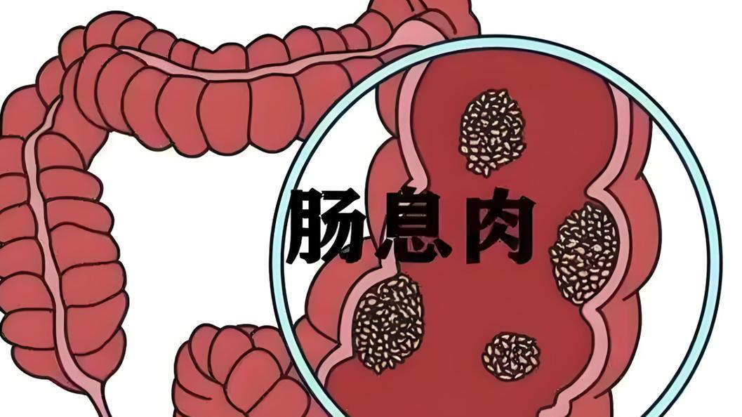 体检查出肠息肉，别紧张，早期做肠镜是关键，早期发现早切除