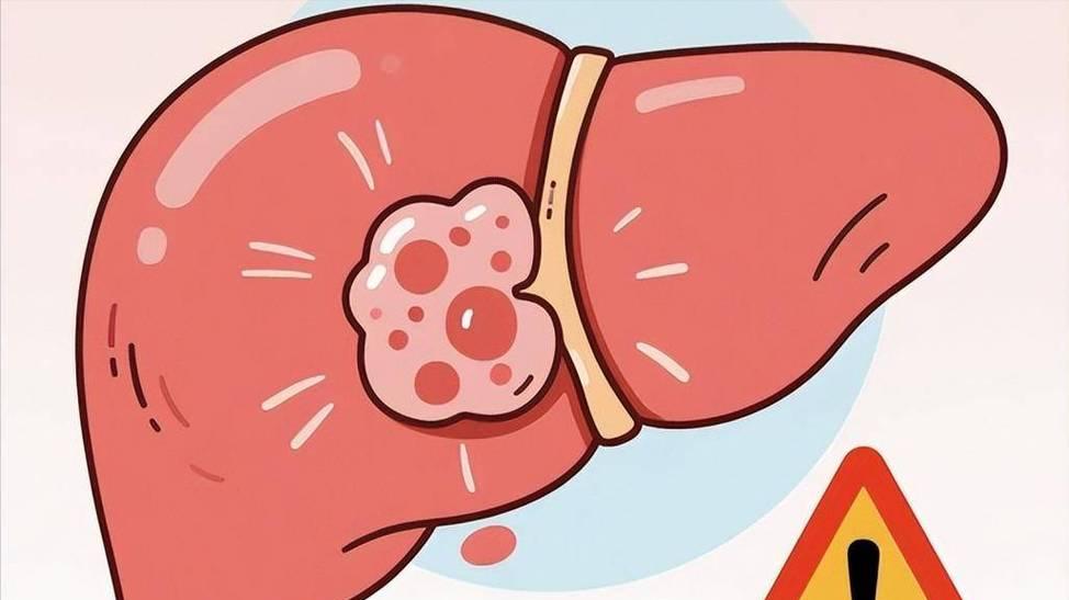 体检查出肝囊肿，是肝脏长了肿瘤吗？医生教你读懂“肝水泡”