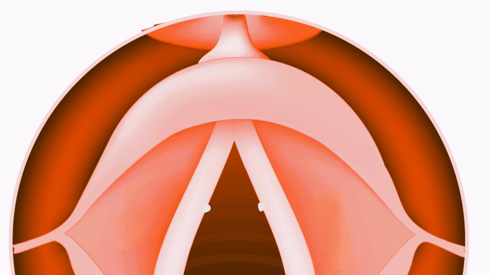 嗓子总嘶哑，说话费力？——声带小结的早期信号！