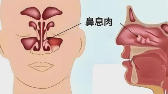 鼻子里长肉球！鼻息肉原来危害这么多！别大意，警惕这些危害！