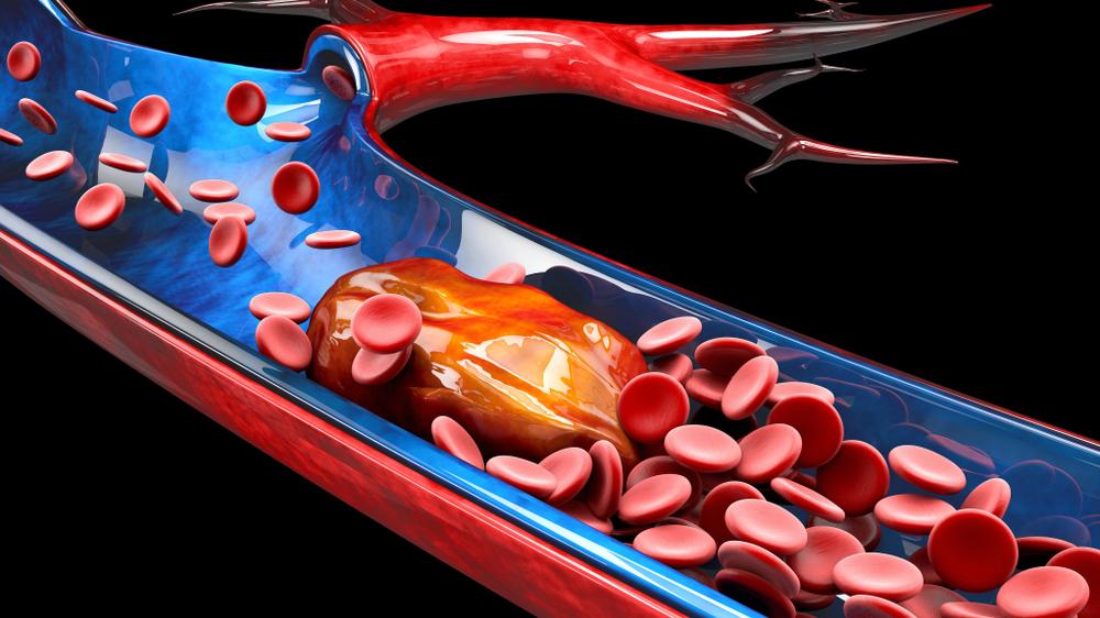 甘油三酯升高有救了！3个月用一次的新药刚刚获批，降幅达80%