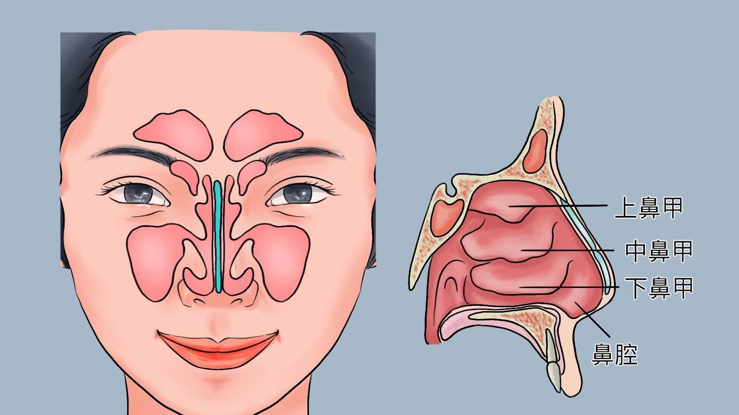 夜里总被“憋醒”？警惕鼻炎的升级版——鼻甲肥大