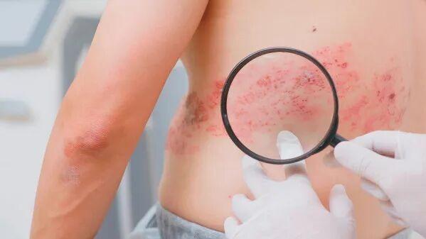 HIV感染者的带状疱疹风险高出常人两倍：疫苗接种是预防的首选吗？