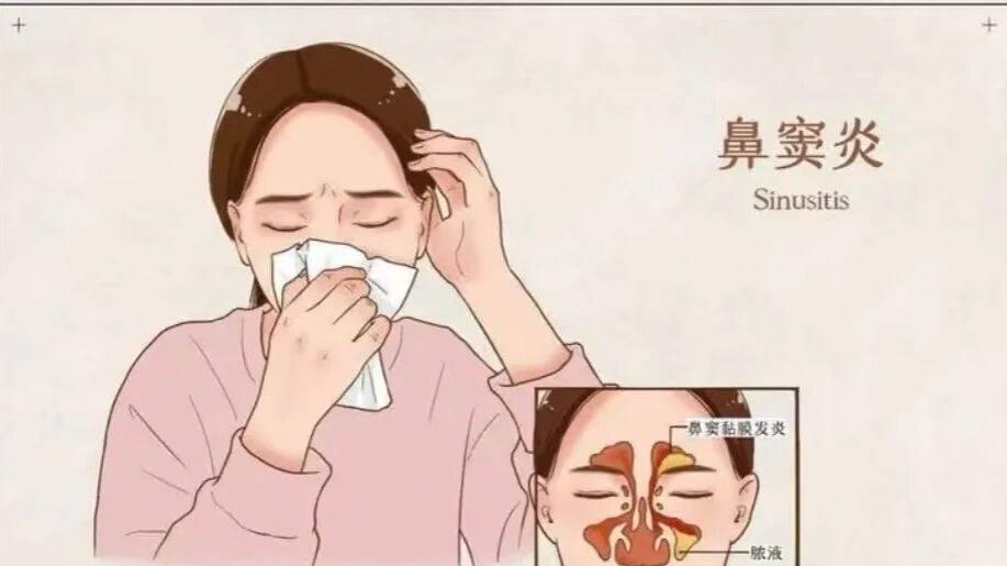 没完没了的流鼻涕，当心慢性鼻窦炎！