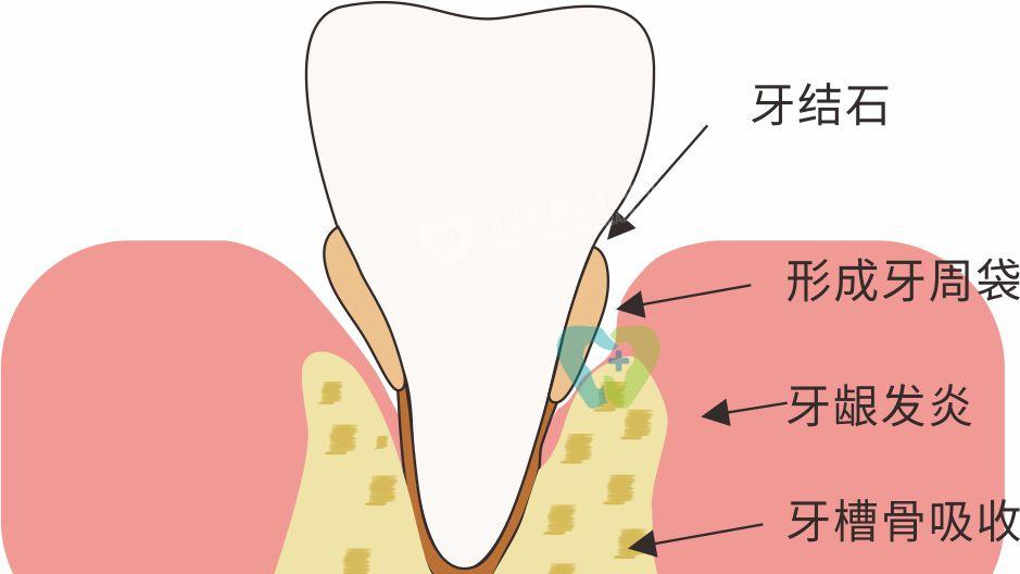 牙齿发炎靠硬扛？揭开牙髓炎及牙周炎无法自行修复的深层原因