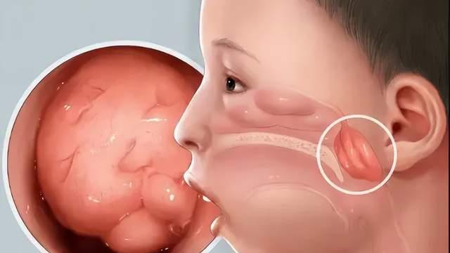 郑州民生耳鼻喉医院儿童扁桃体、腺样体肥大科普