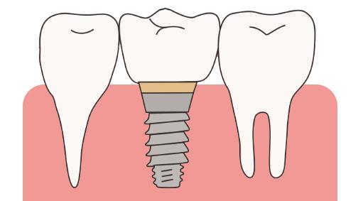 种植牙能用一辈子吗？它和真牙的区别，一次说清楚
