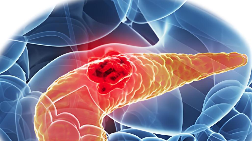 身体出现3类症状，别硬扛，可能胰腺癌在敲门，5类人群做好预防