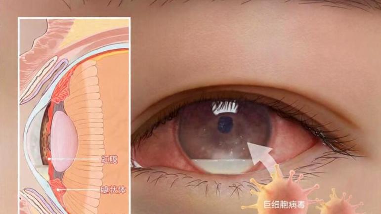 眼前有黑影，以为是 “飞蚊症” ，竟查出艾滋 ? !