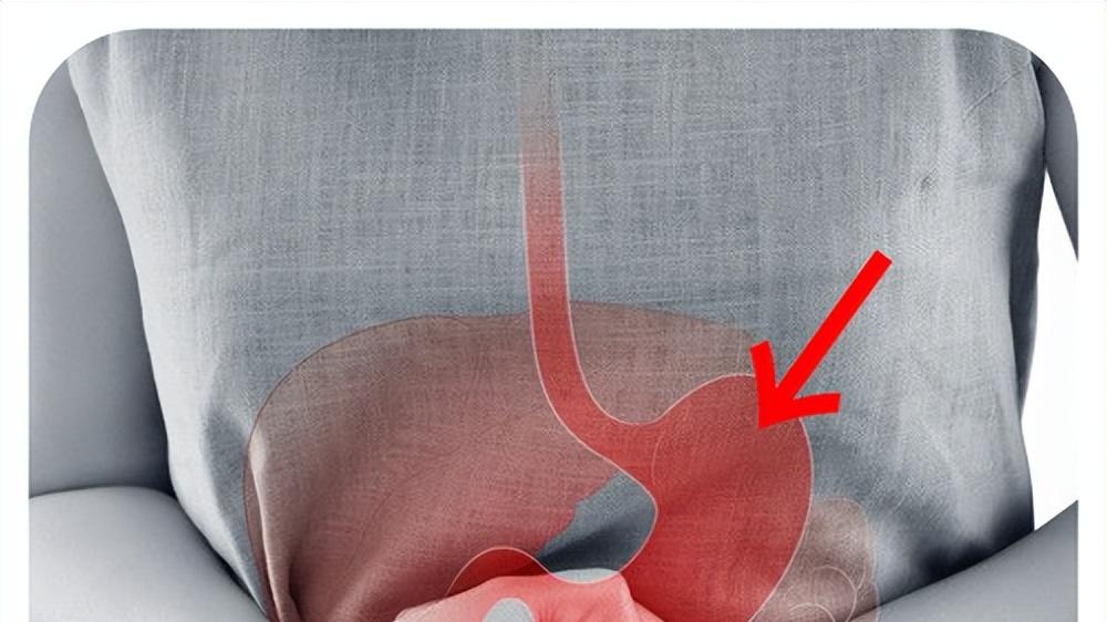 把溃疡当胃炎扛？空腹时烧心？小心十二指肠溃疡，别等穿孔才后悔