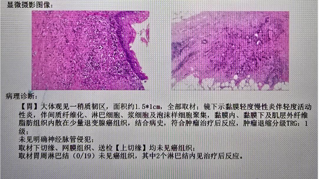 胃癌晚期就没救了？转化治疗+精准手术，让“绝症”变“可治”！
